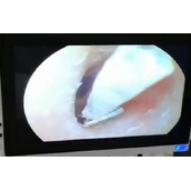 女生睡觉不摘耳钉：直径4mm钻掉耳道 卡了半个月！