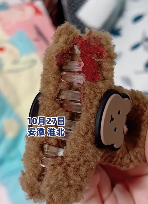 13岁女孩戴鲨鱼夹滑倒：头皮缝了3针 妈妈提醒大家尽量少戴！