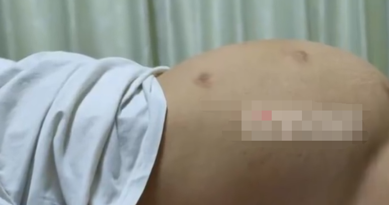 女大学生肚子大被搓澡阿姨救了一命 20厘米的大瘤子！