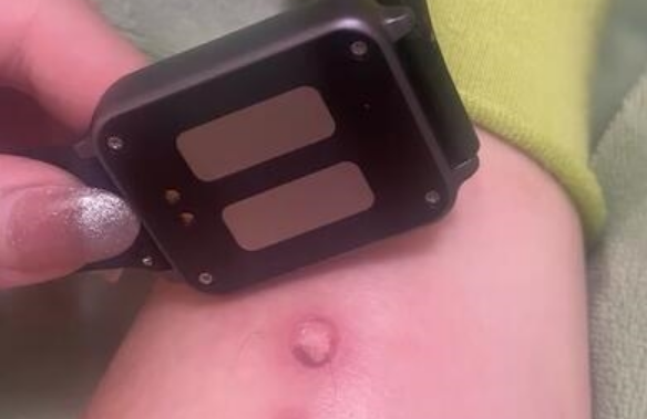 女生为考研戴电击手表叫起床被电伤：睡了12小时没被叫醒！