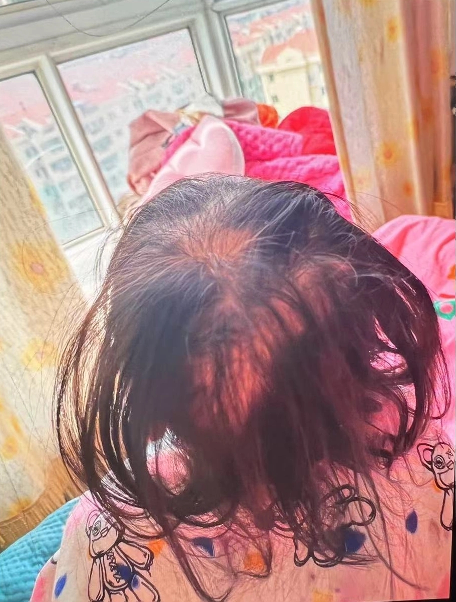 3岁女童突然脱发 查出铊中毒 医生：毒性高于砒霜