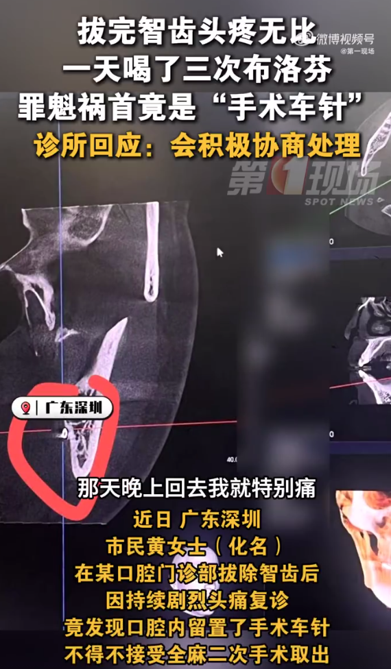 女子拔完智齿头痛难忍嘴里竟有根针 一天喝了三次布洛芬