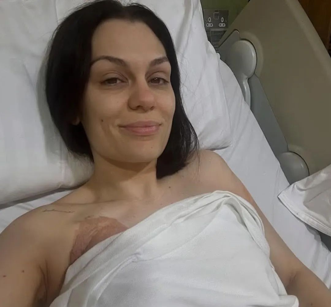“结石姐”Jessie J分享乳腺癌术后照片：病容憔悴