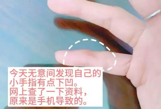 用小拇指做手机支架的受害者出现了：手指显现明显凹痕